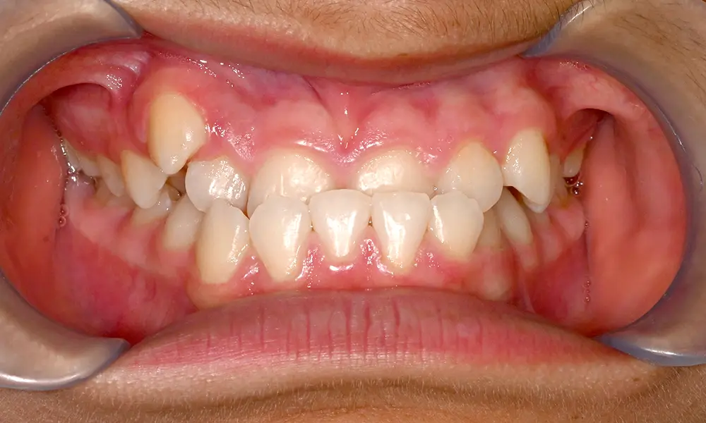 Antes