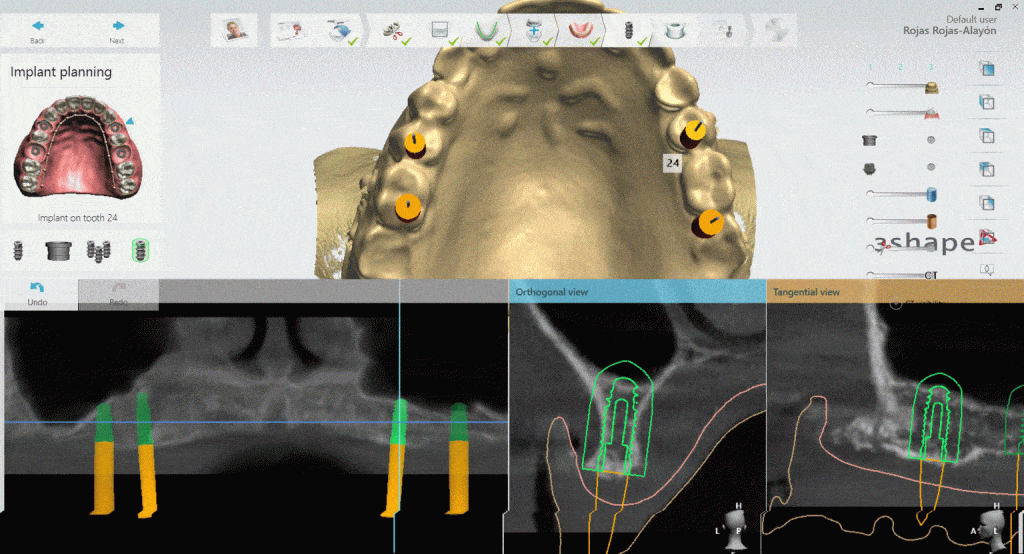 Costos de un Implante Dental